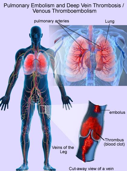 Venous Thromboembolism