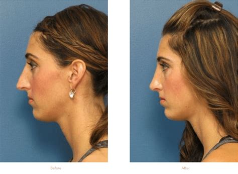 How Soon Can I Return To Work After A Rhinoplasty Raleigh