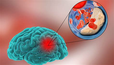 Diferencias Entre Hemorragia Cerebral Y Accidente Cerebrovascular