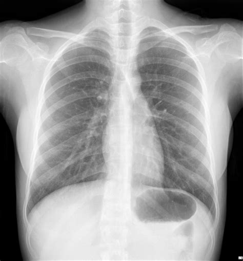 Chest X-Ray Interpretation in patients with fever, cough, colds