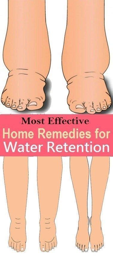 Water Retention Is A Medical Condition That Describes Swelling Thats