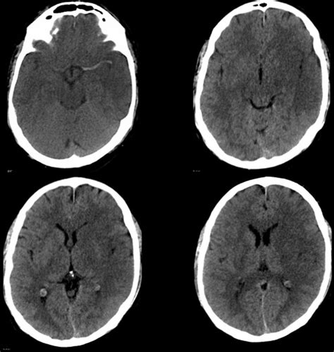 Brain Ischemia Ct And Mri Techniques In Acute Ischemic Stroke