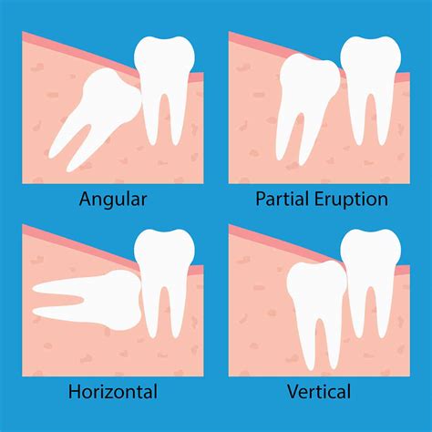 Wisdom Teeth Removal Monroe And Mint Hill Union Oral Surgery