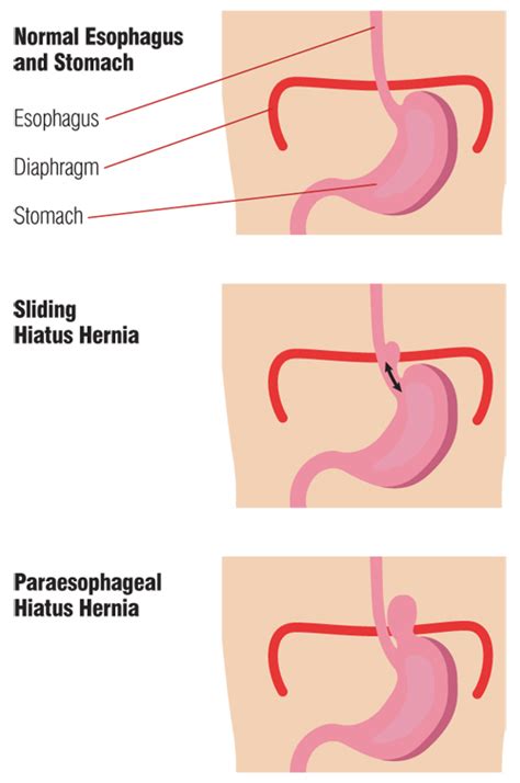 Normal Esophagus And Stomach Vs Sliding Hiatus Hernia Vs Paraesophageal
