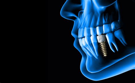 Dental Implants And All On 4 Croatia Polyclinic Šlaj Anić Dentistry And Skincare