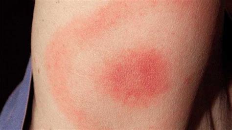 Cat Scratch Itchy Bumps - toxoplasmosis