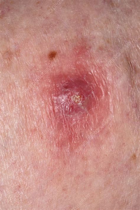 Skin Cancer On The Leg Stock Image C Science Photo Library