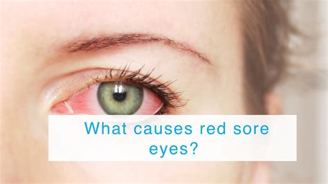What Causes Red Sore Eyes Youtube