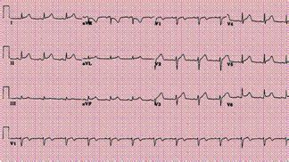 Prin durere toracică, frecătură pericardică, modificări electrocardiografice și revărsat. PERICARDITE ACUTE SI CRONICE - Cauze de afectare pericardica