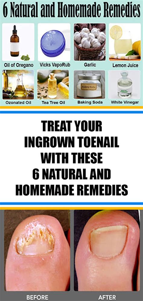 Treat Your Ingrown Toenail With These 6 Natural And Homemade Remedies