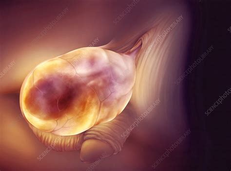 Swollen Scrotum Stock Image M Science Photo Library