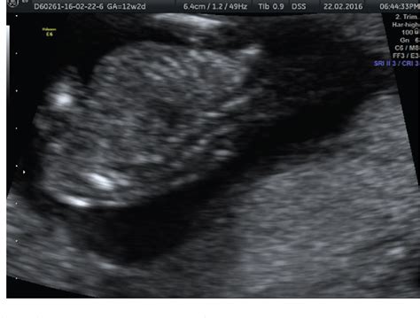 Figure 2 From Prenatal Diagnosis Of Fetal Hemivertebra In The First