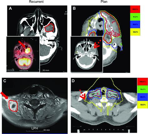 A D Failure Patterns In Helical Tomotherapy Ht Patients A For
