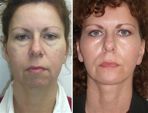 You can call at +1 954 446 6464 or find more contact information. Weekend Facelift Gallery Richmond VA | Cosmetic Facial Surgery