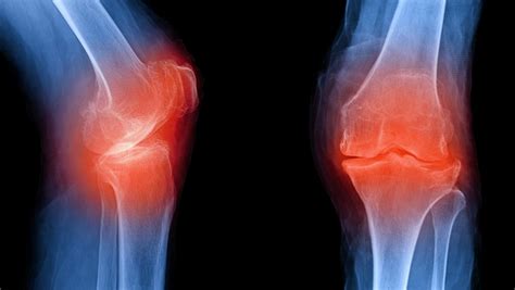 Prp Injections No Better Than Placebo For Knee Osteoarthritis