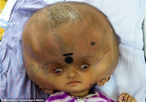 However, if you do enough research short hair in front is a wonderful way to direct the attention to the long hair in the back. Boy with world's largest head has surgery to remove fluid ...