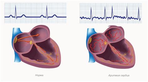 Arytmia leczenie środkami ludowymi i lekami rodzaje przyczyny objawy zaburzeń rytmu serca