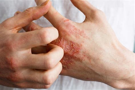 Atopic Dermatitis Atopic Eczema — Fora Dermatology General