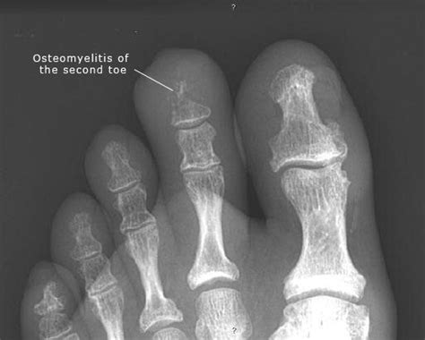 Xray Of Broken Pinky Toe The Request Could Not Be Satisfied