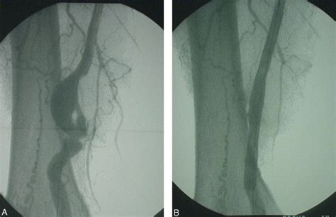 Endovascular Treatment Of Popliteal Artery Aneurysms European Journal