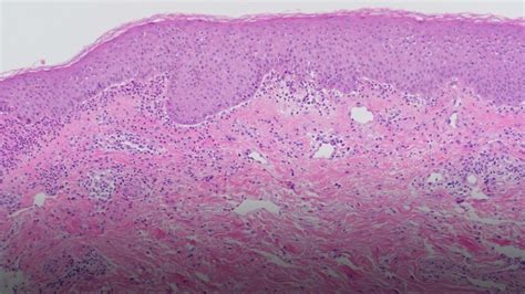 Collagen Vii Autoantibody Mediated Subepidermal Autoimmune Blistering