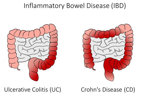 Crohns And Colitis Upopolis