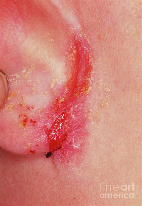 Close Up Of Eczema On Ear Lobe Photograph By Dr Hcrobinsonscience
