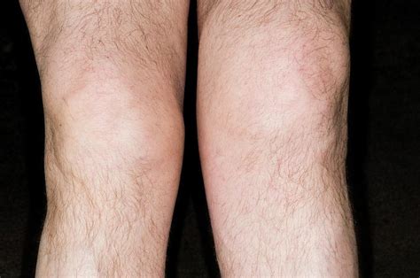 Swollen Knee Photograph By Dr P Marazziscience Photo Library