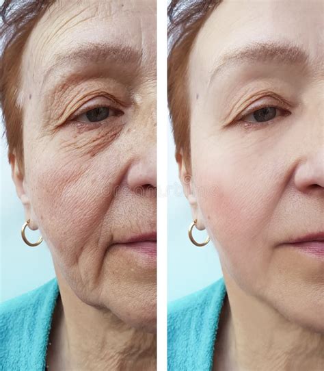 Face Of An Elderly Woman Wrinkles Patient Health Hydrating Therapy