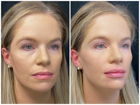 Patient 56163179 Dermal Fillers Before And After Photos Austin Face And Body