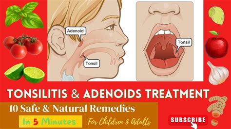 10 Best Effective Proven Home Remedies For Enlarge Swelling Adenoids