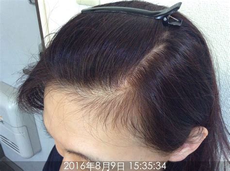 100+ EPIC Best M 字はげ 前髪 女 - 今日は楽しかった