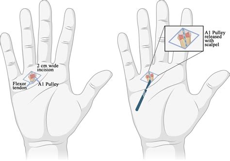 Image A With An Open Surgical Approach To Release The A1 Pulley By