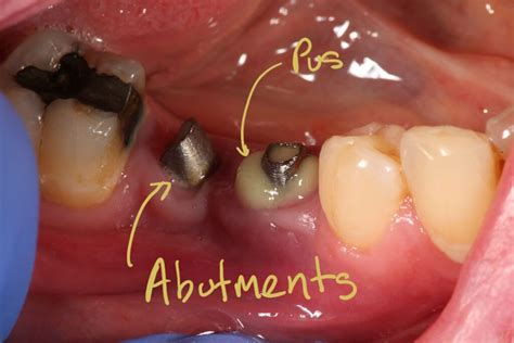 Pus Around A Dental Implant Dr Gurs Sehmi