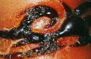 Permanently scarred may occur, depending on the severity of the infection. Tattoo Infection - Pictures, Symptoms, Treatment, Causes