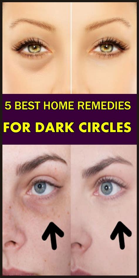 5 Best Home Remedies For Dark Circles