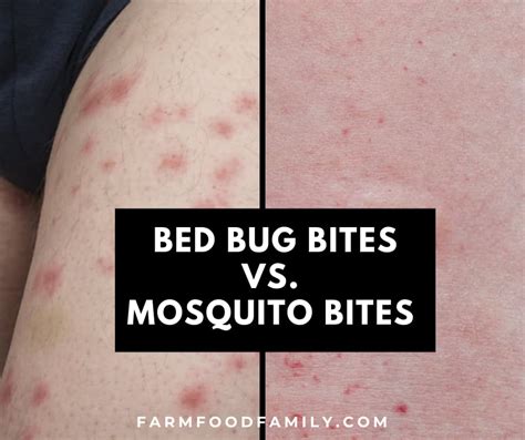 What To Do About Bed Bug Bites Best Hotel Bed