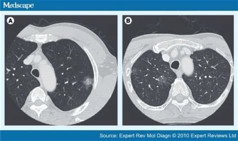 Detection Of Early Stages Of Lung Cancer Based On Imaging A
