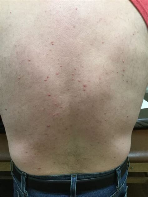 Clinical Challenge Rash On Arms Knees And Back Mpr