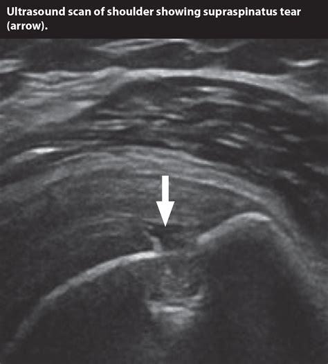 Supraspinatus Tendon Anatomy