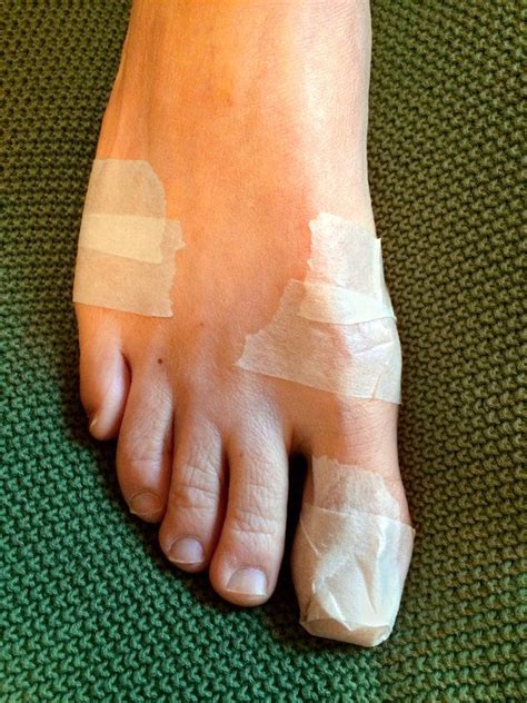 An Easy Way To Prevent Blisters Try Tape Prevent Blisters
