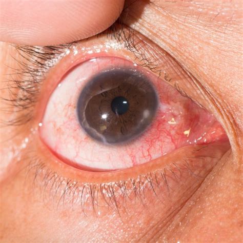 Signs and symptoms of keratitis include: marginale keratitis op oogtest — Stockfoto © arztsamui ...