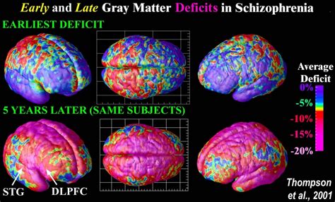 Schizophrenia Summing It Up Emotion Brain And Behavior Laboratory