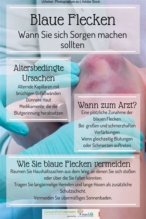 Ursache ist meist eine verletzung. Blaue Flecken - Ursachen eines Hämatoms | Naturheilkunde ...