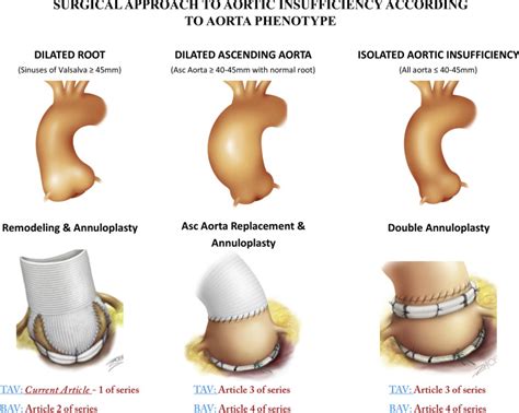 Valve Sparing Aortic Root Replacement Using The Remodeling Technique
