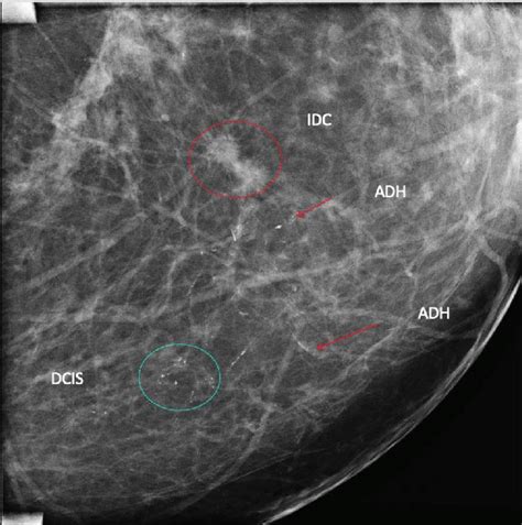 Digital Mammography Lateral View With Magnification Of The Left