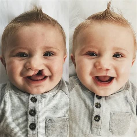 Cleft Lip And Cleft Palate Two Week Surgery Via R
