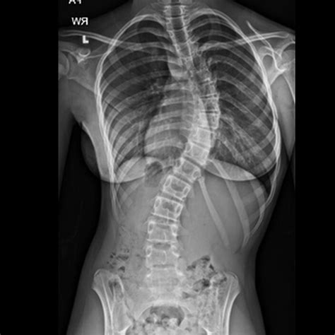 Scoliosis Rib Pain Causes And Treatments Brandon Orthopedics