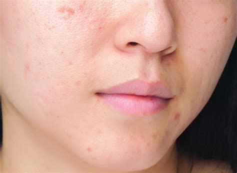How To Remove Dark Spots On Face Naturally Home Remedies For Facial