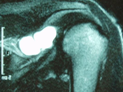 Paralabral Cyst From Labral Tear Arizona Institute For Sports Knees